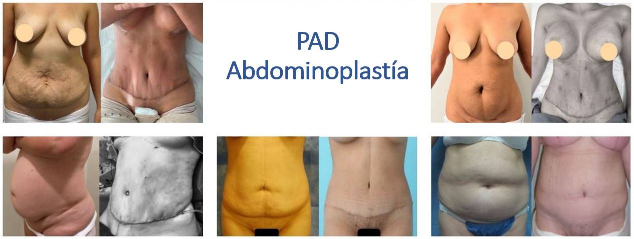 Resultados de abdominoplastia Dr esteban torres